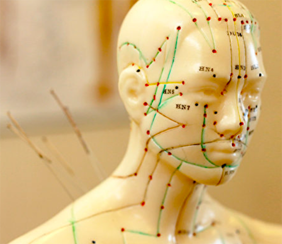 Acupuncture